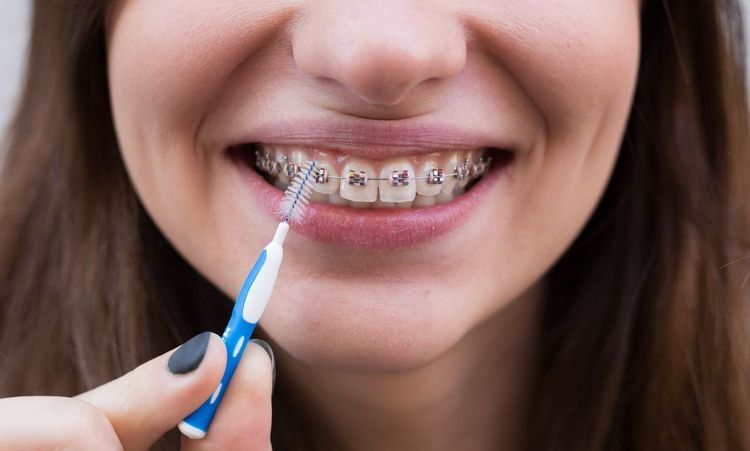 What Happens If You Don't Floss With Braces?
