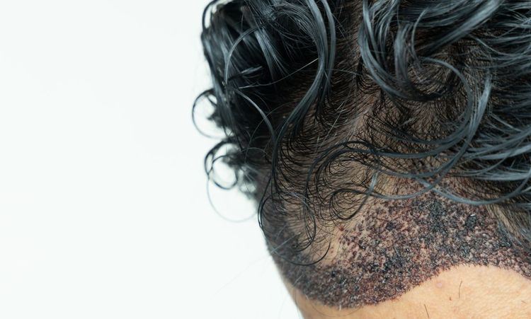 How to Choose The Best Hair Transplant Clinic in Austria