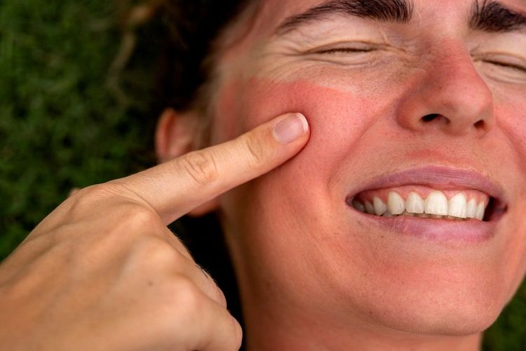 Natural Remedies for Sunburn Skin: A Complete Guide