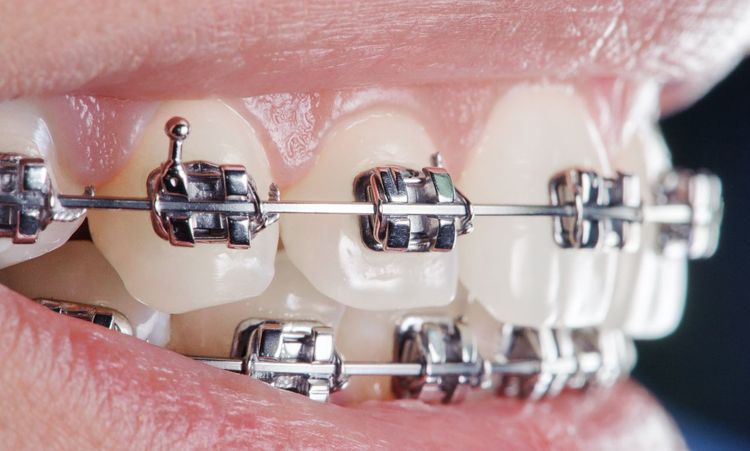 What Happens If You Lose Insurance During Braces