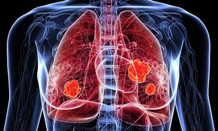 How To Prevent Non-Small Cell Lung Cancer